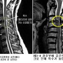 경추 척수증 Cervical spondylotic myelopathy 이미지