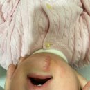 엄마랑 유리드믹스 12-18개월 | 18개월 아기의 선천성모반 제거 수술 후기 (D23코드 보험료 수령)