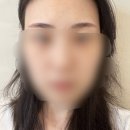 유월의하루 의원 | 대구 수성구 붉은 눈썹문신제거 피부과 내돈내산 후기 [유월의하루의원] 1회차