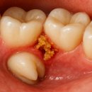 성영희탑신경과의원 | 인천가좌동치과 사랑니발치 생각보다 많은 분들이 오해하고 있습니다