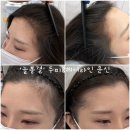 4572 | 동성로 두피문신 ‘늘봄결’ 예비신부 M자·정수리 고민 해결 후기