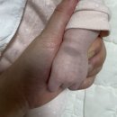 아이엠피부과 | 대전 아이엠피부과 신생아 이소성 몽고반점 치료후기 1회차