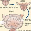 전립선비대증 원인 방법 이미지