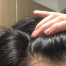 웰빙약국 | 남자 정수리 탈모 극복기 종로 탈모약 처방 병원 약국 방문 후기