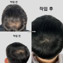 디그노스칼프 | 구리두피문신, 자연스럽고 풍성하게 바꾸고 싶다면 디그노스칼프에서 시작하세요