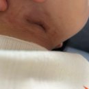 대공원 동물병원 | [소아외과 수술후 회복 완료] 장액종/ 서울대학교어린이병원 양산부산대학교병원/ 갑상설관낭종기록