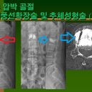 압박골절 - 압박골절의 치료 이미지