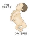 ARC 증후군 (Arthrogryposis, Renal Dysfunction, Cholestasis, ARC Syndrome) 이미지