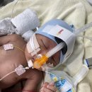 11650-14-38-19 | RDS 치료후기 /신생아중환자실 입원후기/Nicu 입원후기