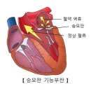 승모판막 폐쇄 부전증[mitral regurgitation] 이미지