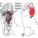 hallucis trigger point 이미지