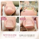 창신로 | 청주내성발톱교정 미라쓰네일, 병원만 찾던 동생이 선택한 관리 후기