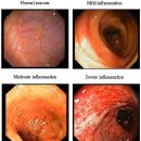 ?궤양성대장염 이미지