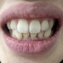 제일플러스 | [잇몸관리템 추천] 치탄플러스 실제 사용 후기와 효과
