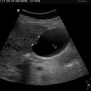 mets of the liver suggested origin lung ca or colon ca 이미지