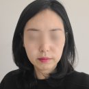 김해피부과 이마필러 보톡스 팔자주름필러 스킨보톡스하고 대만족 후기