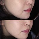 우아한여성의원 | 세르프 300샷 vs 600샷, 전후 사진과 실제 후기