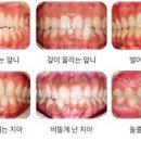 교정 치료[orthodontic treatment] 이미지