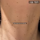 동광빌딩 앞 | [내돈내산] 대구/ 신세계가정의학과/ 편평사마귀 제거 후기 (일주일차)