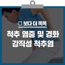 젊은 나이에 3개월 넘게 허리 아픈 남성, '강직성 척추염' 의심을 이미지