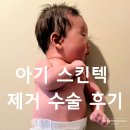 코드텍 | 부산 돌아기 스킨텍(귀젖) 부이개 제거 수술 시기, 비용, 보험 청구, 흉터 생생 후기