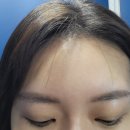 CMC정비 | 엘란쎄 이마 필러 후기(장점, 부기, 볼륨 전후 모습)