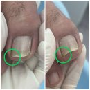 L's NAIL(엘스네일) | 내성발톱 고름 해결 후기 l Ingrown Toenail Correction Before & After 2Visit Transformation