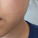 고은어린이집 | [천호피부관리 고은결에스테틱] 트러블케어 후기