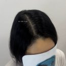 김포 | 출산 후 정수리탈모 김포두피문신 후기