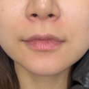 111의원 | 신사역 하이미의원 입술필러 내돈내산 후기