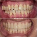 40대 인비절라인 투명교정 무삭제라미네이트 젤라미 압구정교정치과 치료 후기 1년 4개월 기록 사진