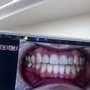 원데이치과의원 | [레브치과] 치아미백 원데이 3회 후기 🦷 /내돈내산