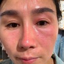 와 | 주근깨 레이저 후기 와 장희빈미안법