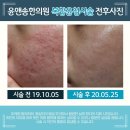 여드름패인흉터치료 후기 사진 보고 결정하세요