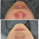 한단계 | 마포피부관리 받고 피부톤 한 단계 후기