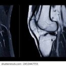 무릎에 물찼을때 병원 물이 차는 이유 이미지