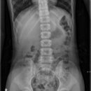 Abdomen(복부) Supine 이미지