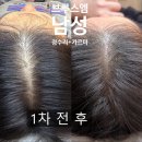 엠두피엔아트월드 | 파주두피문신 후기, 자연스러움 차이는 브루스엠