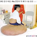 45kg 엉덩이 혹 제거한 중국 여인 이미지