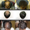 엠디코리아㈜ | 탈모, 빈모 커버-흑채, 애즈모 이야기