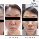 인셀덤루비 | 인셀덤 2개월 사용 후기