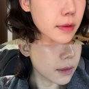 이브 | 신논현 피부과 중안부 축소 리프팅 이브타이탄 2주 후기