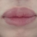 (사진있음)입술 보톡스+필러 리터치 2번한 후기[광양 뷰티드 1.0 의원]