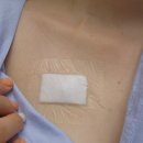브라카 | 삼중음성 유방암 브라카 변이 린파자 1년 복용 끝