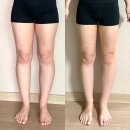초원체형관리 | 송도다이어트병원 대용량 지방분해주사 3회차 한달 후기｜허벅지 실라인주사 기록