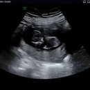 학익2동행정복지센터(37151) | [임신 12주] 아인병원 1차 기형아 검사 비용 &amp; 목투명대 1.31mm 통과!