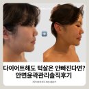 턱살빼는법 부천 뷰티멜로우 안면윤곽관리 솔직후기