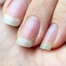 손톱에서 “이 증상” 보인다면 갑상선 초기 확률 90%입니다! 이미지