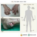 리노류마내과 | [경산통풍] 통풍증상, 자연적 경과 4단계