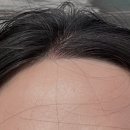 씨에스엘엠지에프두피탈모센타천안 | 아산 두피관리 센터 'CSLMGF 두피탈모센터 아산점' - 스위스 여행 후 타버린 두피 살린 후기